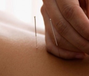 Cupping, Gua Sha, and Acupuncture: Can They Help with Arthritis and Chronic&nbsp;Pain?